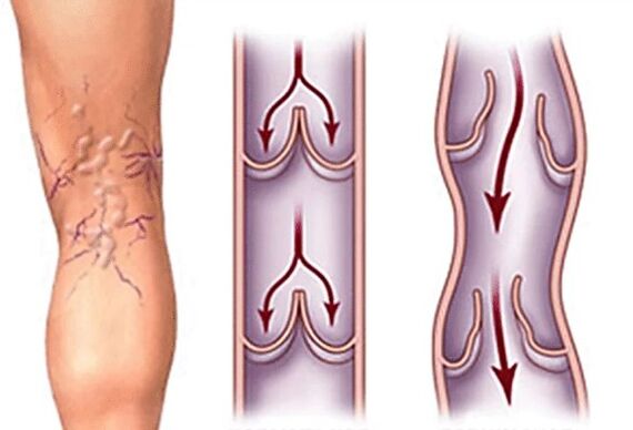 Normal vein and varicose