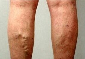 Thrombembolism