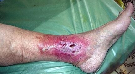 The complications of the varicos