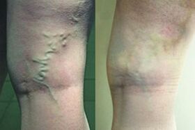 Varikoos veins on the legs