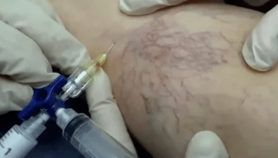 sclerotherapy to treat varicose veins
