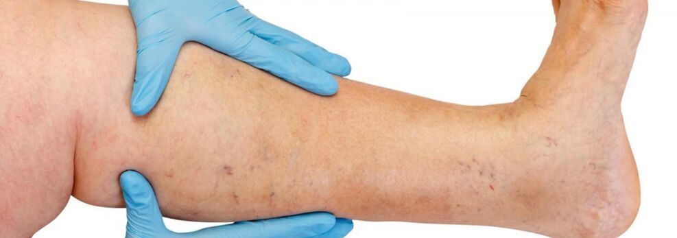 Varicose veins on legs